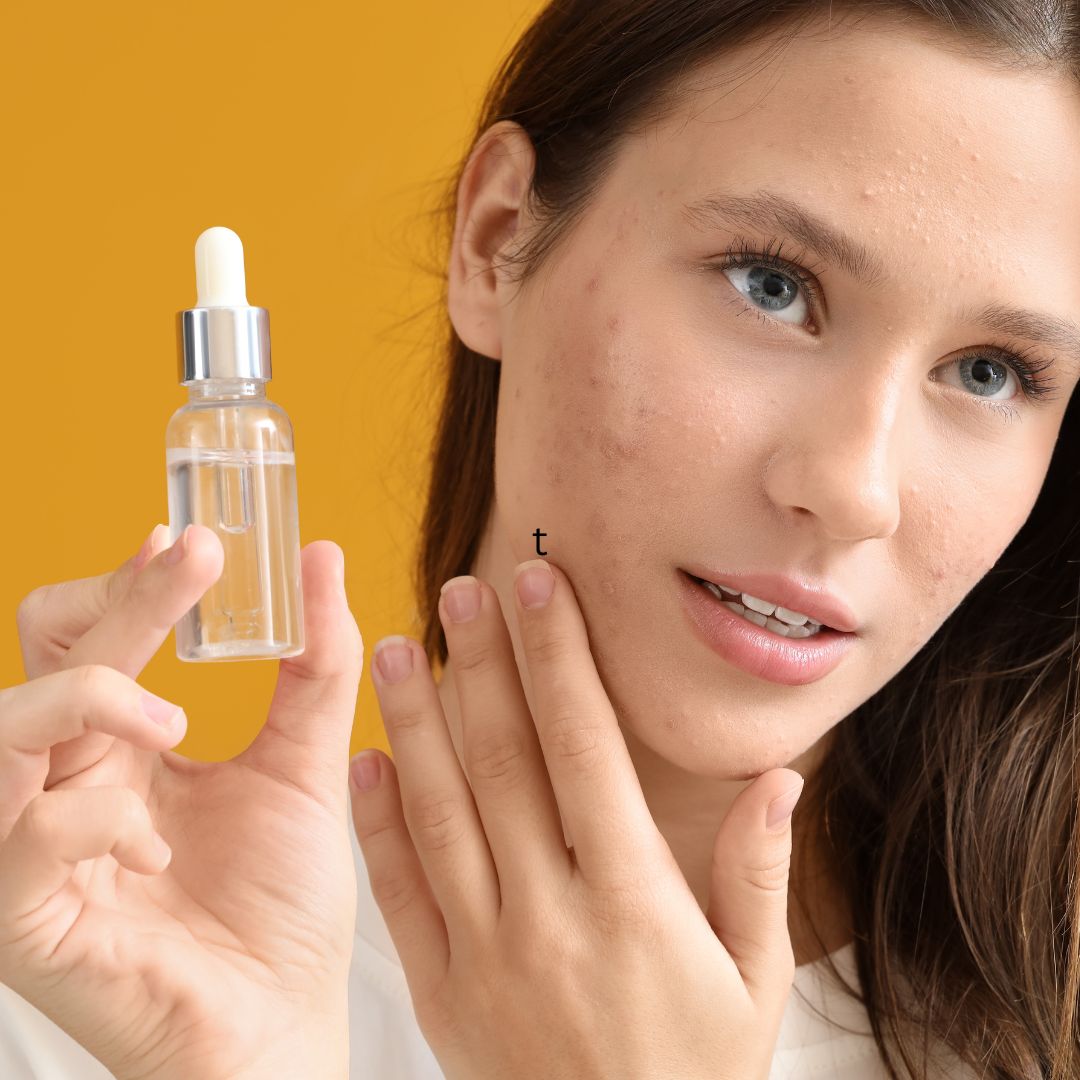 Acne Spot